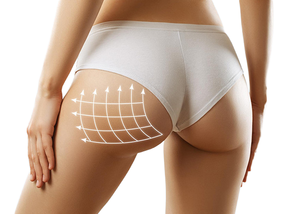 BBL – Brazilian Butt Lift